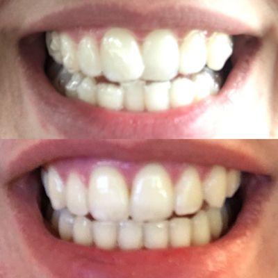 Before and after (Invisalign)