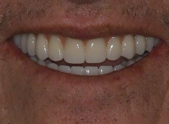 Beautiful smile with implant supported dentures