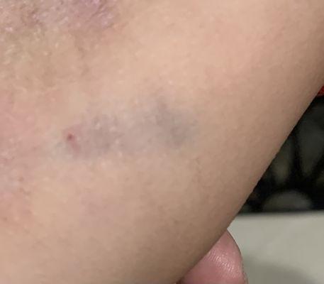 This patient does not take blood thinners or is anemic. The bruising came directly from the vein puncture technique.