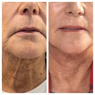 Incredible results with signature multi-approach complete facial rejuvenation!