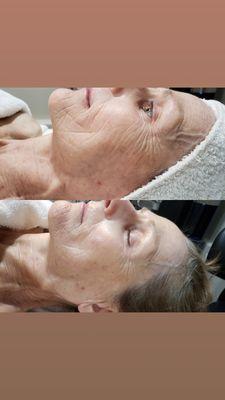 Before and after photos after 1 microdermabrasion facial