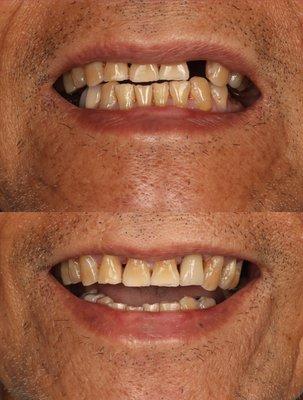 Real patient, real results. Same day smile. Patient had his broken tooth removed and an implant placed in the same visit.
 #dental implant