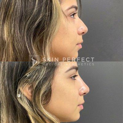 Non-surgical nose job