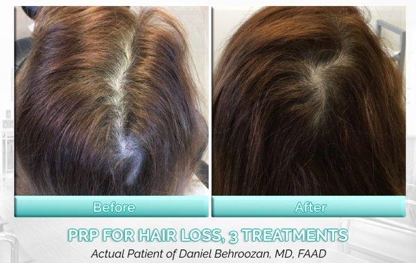 Age-related thinning of the hair can be treated non-surgically with PRP treatments. Treatments are fast, and require no downtime!