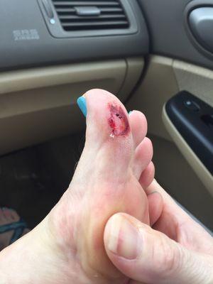 This is the state of my mother's toe upon leaving. Seriously, be careful.