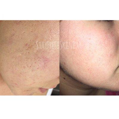 Before and after two microneedling treatments. Pictures are 60 days apart