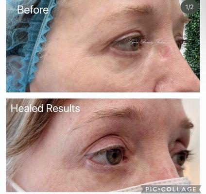 Plasma fibroblast double eyelid healed results