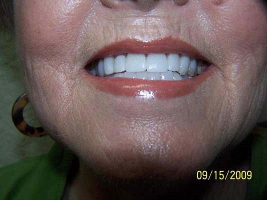 after veneers