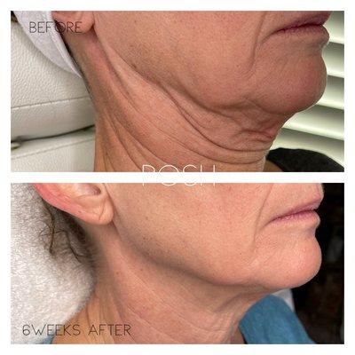 Fibroblast Plasma Skin Tightening