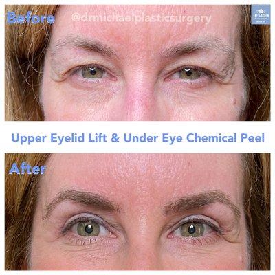 Upper Eyelid Lift at The Garden Medical Spa