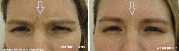 Botox treatment of wrinkles around eyes