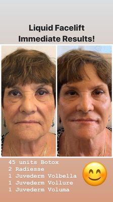 Before and Immediate After - Liquid Facelift