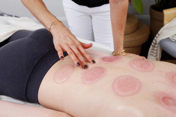 acupuncture + cupping