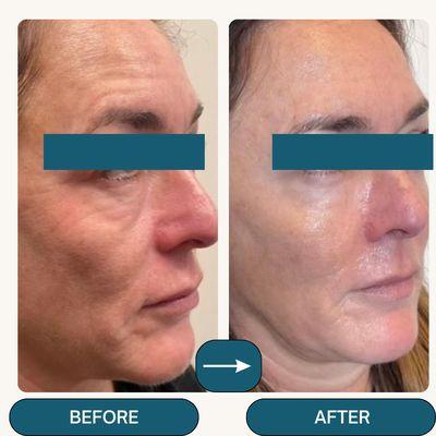 The transformative power of PRP MicroNeedling + PRP Injection! Tighter, firmer skin after just one treatment!