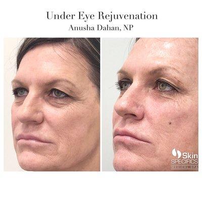 Undereye rejuvenation with dermal filler