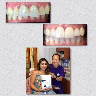 Jaime just had 2 front veneers placed, teeth whitening, and a great cleaning! Her old veneers caused inflamed gums.