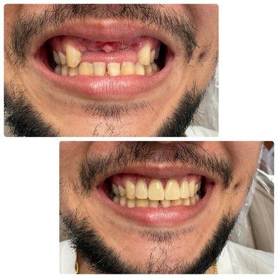 Partial denture while patient is waiting for implants.