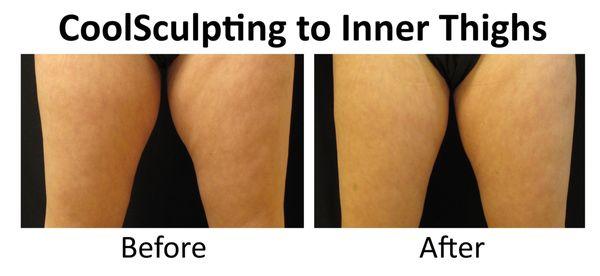 CoolSculpting to Inner Thigh