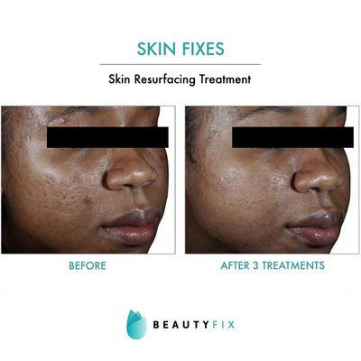 Radiofrequency microneedling for texture, pore size and acne scars.