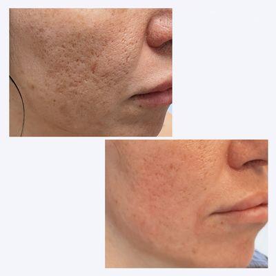 Before and After 3 microneedling and PRF treatments