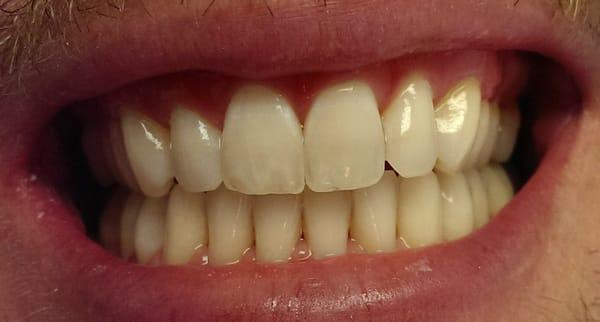 Zoom Whitening 'Before' photo. Presidio Dental San Francisco. karamyandental.com