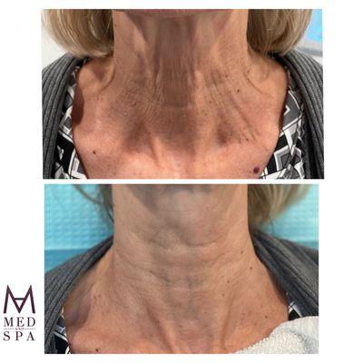 Combination of Morpheus8 & Fractional Laser