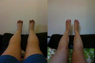 Before and After Lymphatic Drainage.