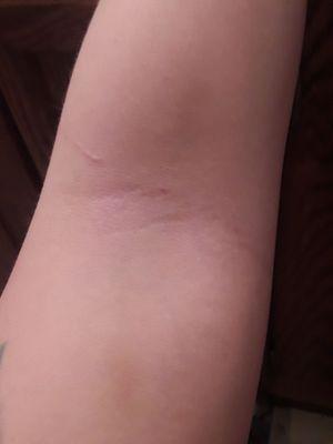 What was left of the bruising, left arm 3/11/19