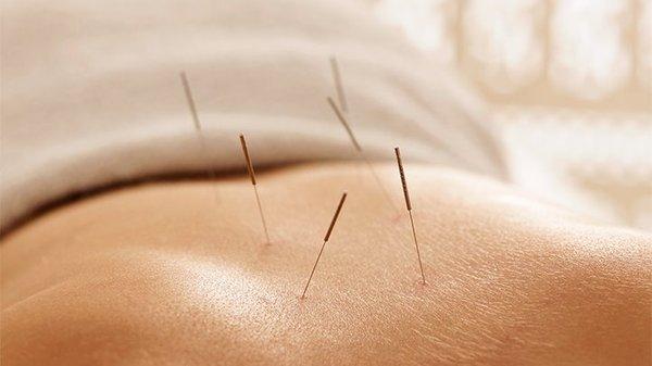 Xiao's Acupuncture