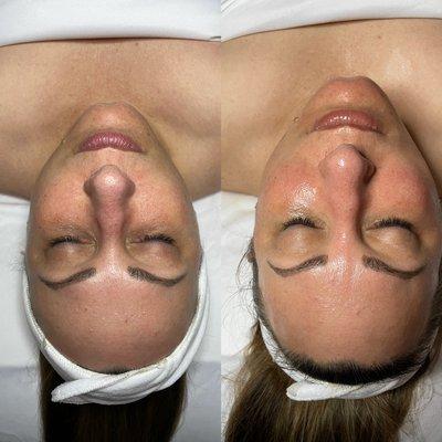 Before and after hydro facial