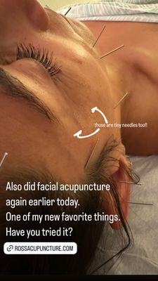 A glimpse at the facial acupuncture