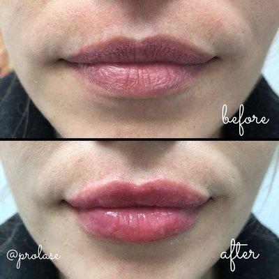 Full, luscious lips with Juvederm lip filler at Prolase.