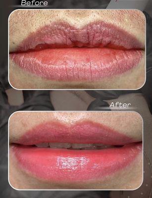 Rejuvenate the lip