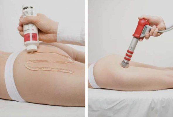 Cellushock wave therapy