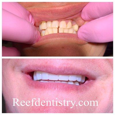 Cosmetic crowns