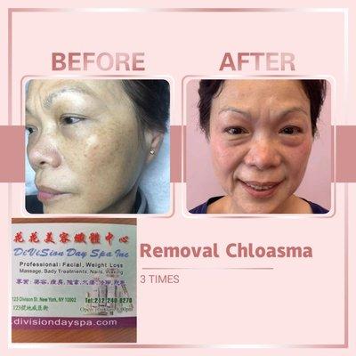 REMOVAL Chloasma 3 TIMES