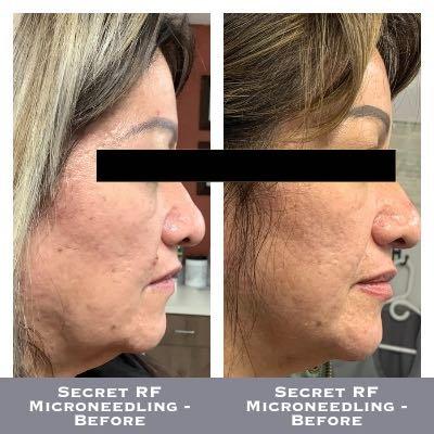 Secret RF Microneedling - Before-After