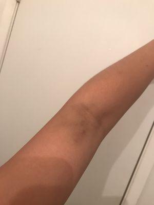 Bruise apparent 5 days after blood draw