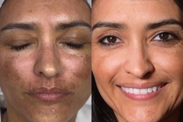 Resurfacing with microneedling.