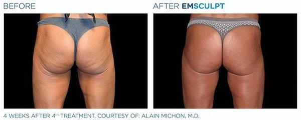 Build muscle while burning fat with EmSculpt!