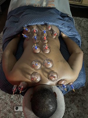 Cupping Therapy