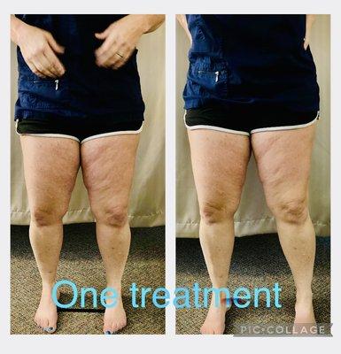 Before and after doing just one Radio Frequency and laser pad treatment for cellulite .