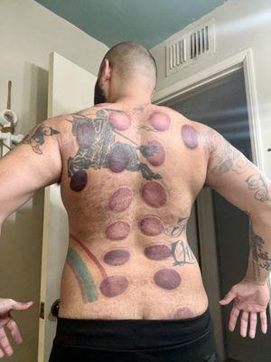 Cupping