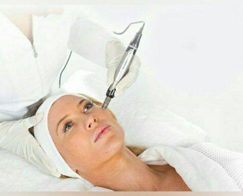 Microneedling