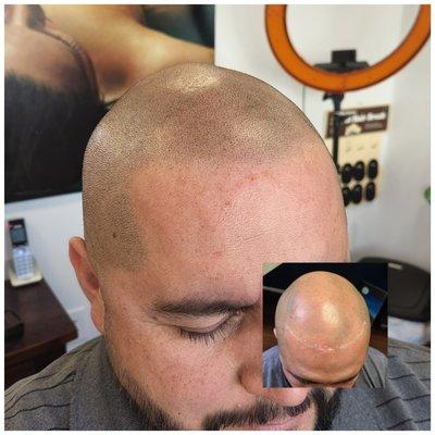 Scalp Micropigmentation by Julie