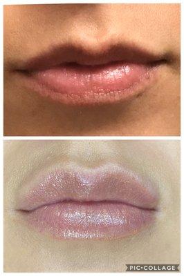 Lip Fillers