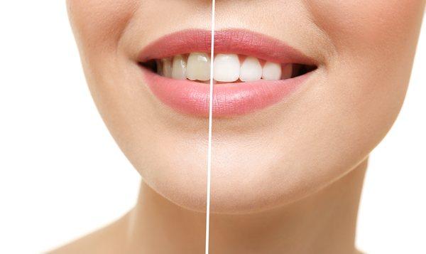 Teeth whitening in West Corona