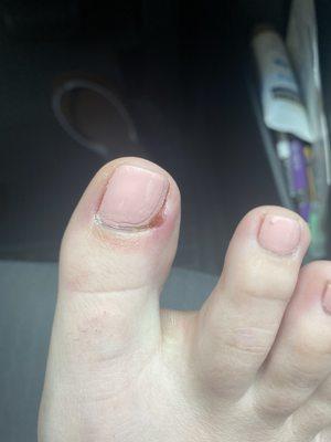 A day after my pedicure. My toe is infected.