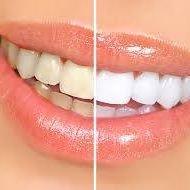 Up to 8 shades whiter with Zoom whitening.  Can only be done in office with a dental professional. Ask about our Zoom treatment!