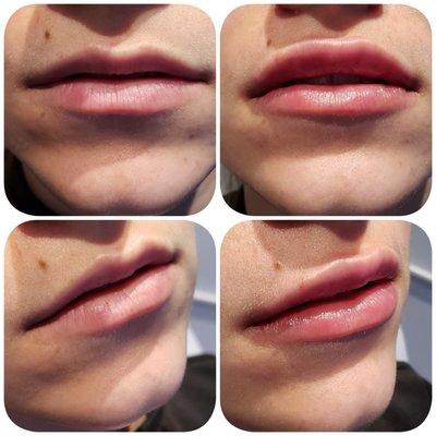 Juvederm for lips